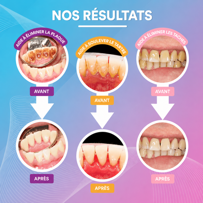 Nettoyeur Dentaire Ultrasonique